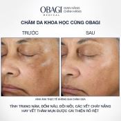 Kem Dưỡng Sáng Da, Mờ Nám Obagi Nu-Derm Blend Fx5  57G-3